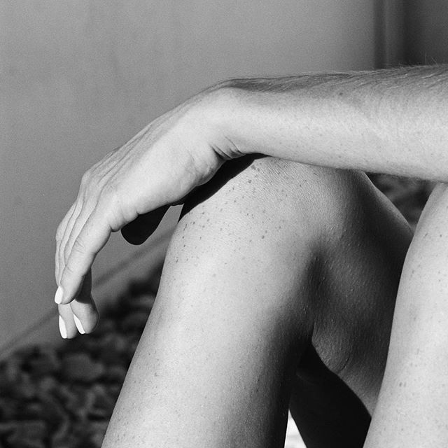 Black-and-white study of an arm resting across a knee, freckled skin — the impact of stress on skin