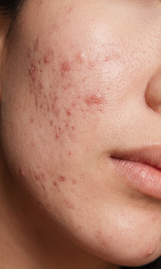 The Biological Drivers of Acne