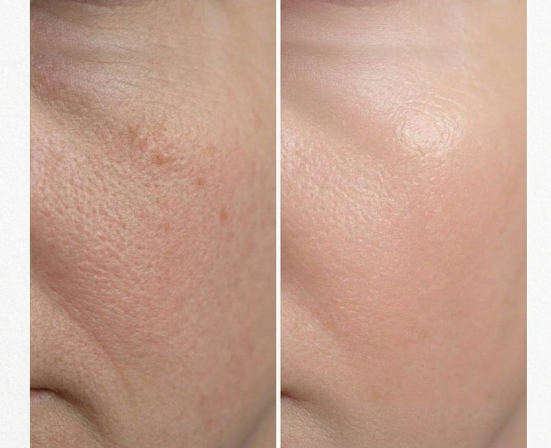 Before and after results showing improved skin texture, reduced redness and strengthened skin barrier after using Aliangé Skincare's Biocinamide Serum with niacinamide and postbiotic Lactococcus ferment lysate, developed by Dr. Alison Jamieson in Australia